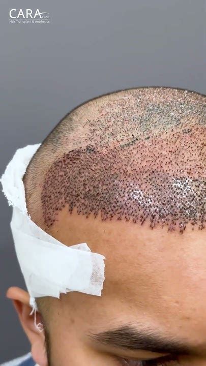 World Class Hair Transplant .
